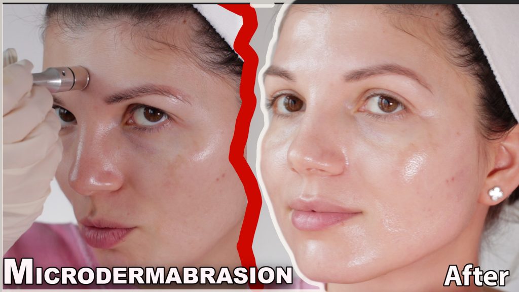 microdermabrasion at home