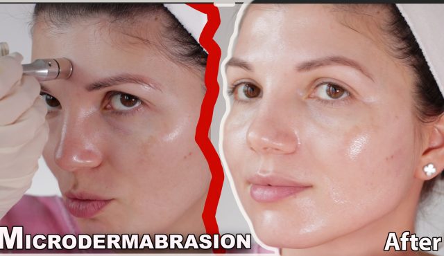 microdermabrasion at home