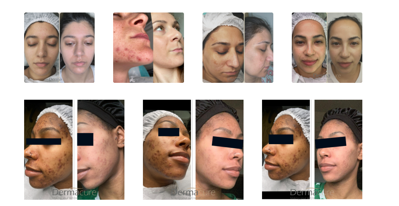 cosmelan peel as a hyperpigmentation treatment