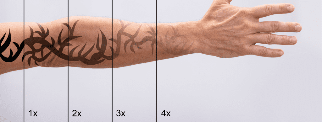 How to become a laser tattoo removal therapist