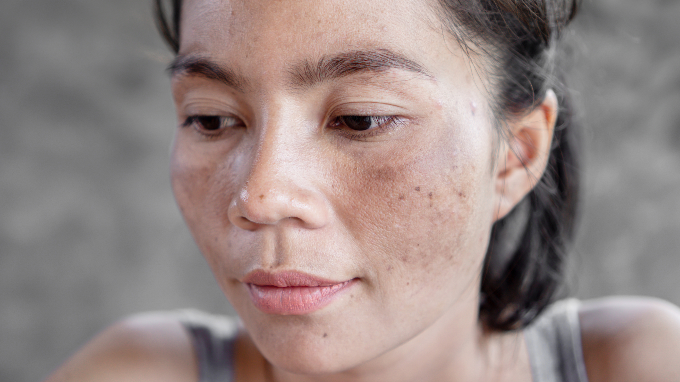 Hyperpigmentation