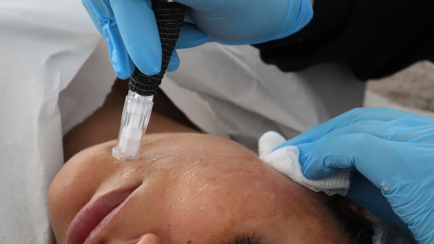 Benefits of microneedling