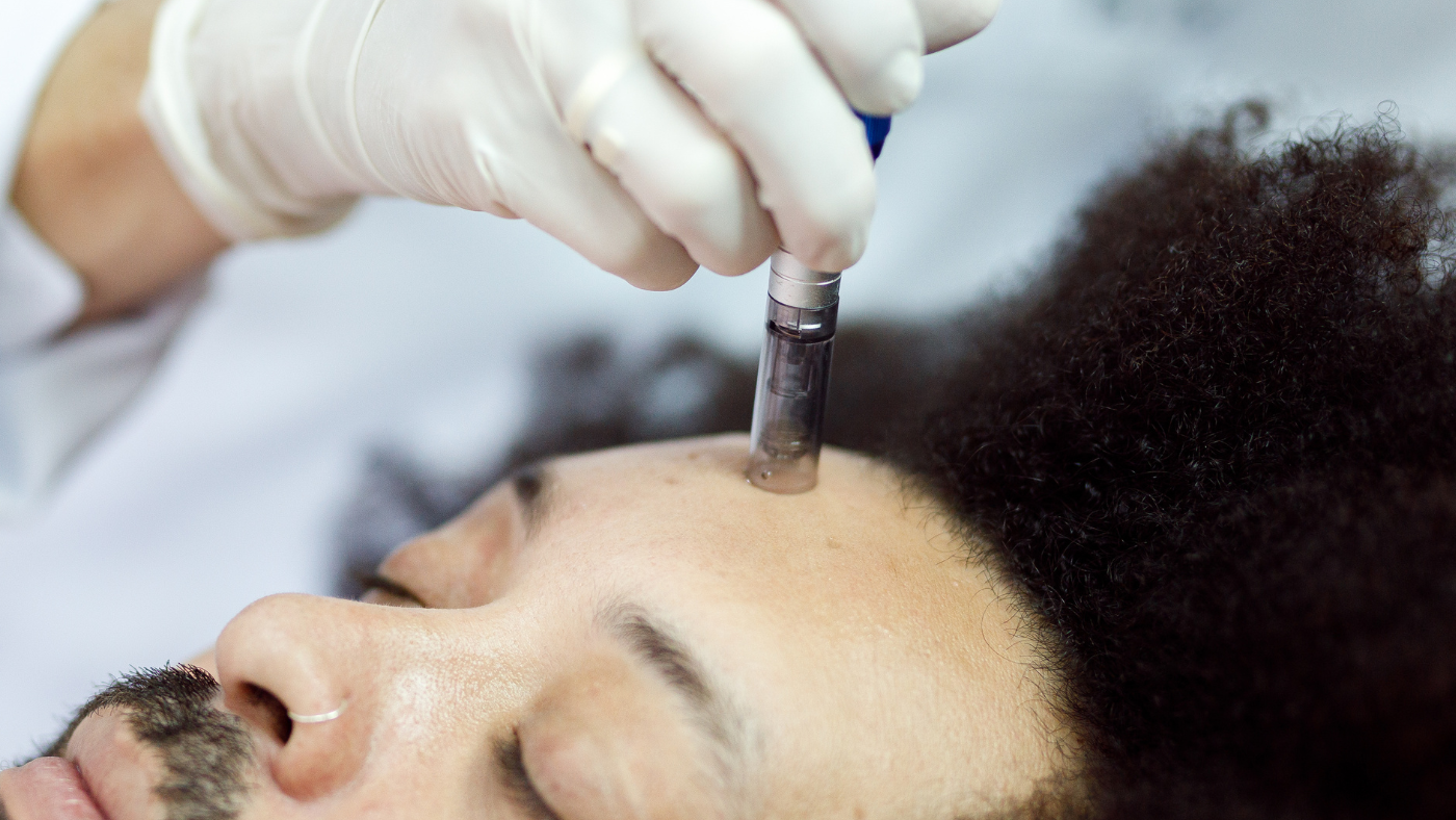 Understanding the Science Behind Microneedling